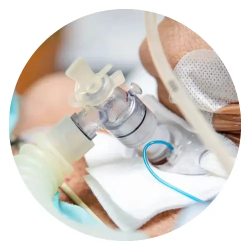 This picture shows a tracheostomy procedure where a hole is made in the neck and a tracheostomy tube is inserted to help breathing through the windpipe